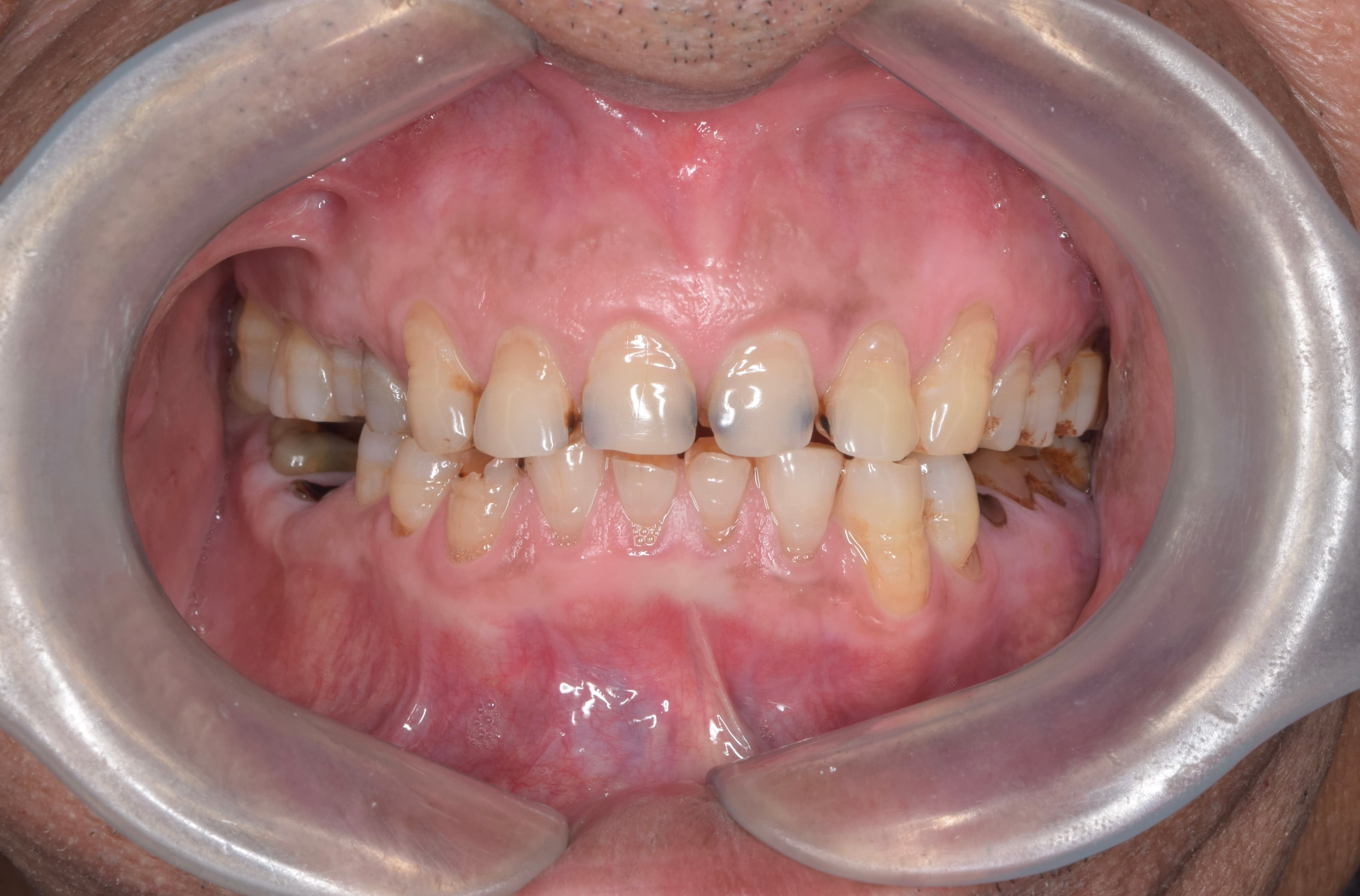 Before — Generalised wear and collapsed bite