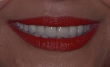 After — Gum and tooth proportion correction