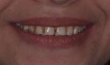 Before — Gum and tooth proportion correction