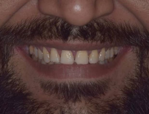 After — Shade correction before a wedding