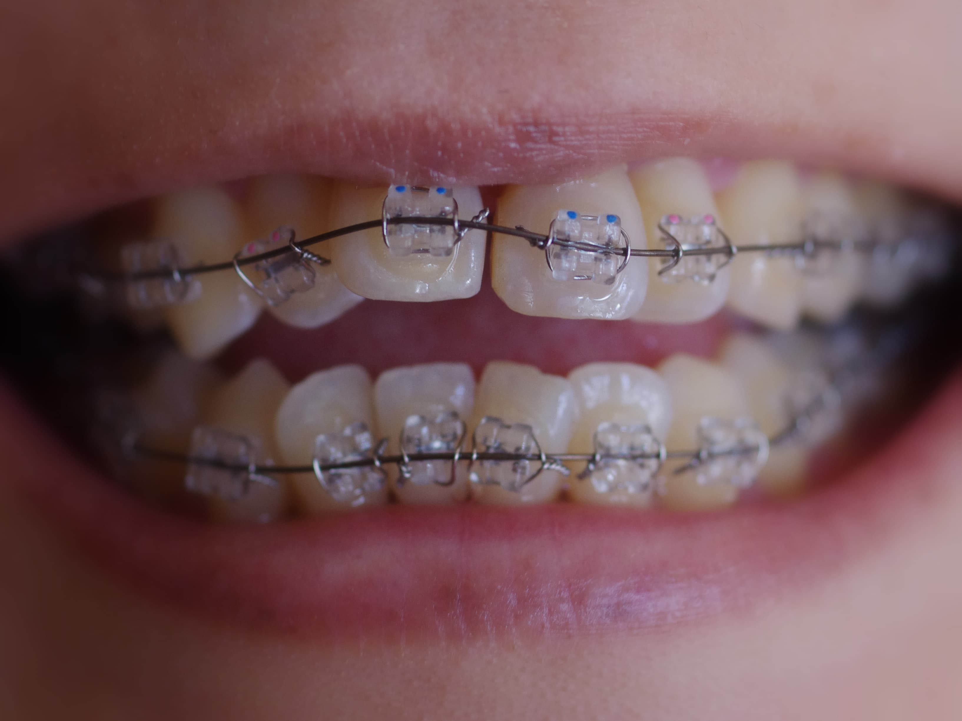 Braces / Aligners