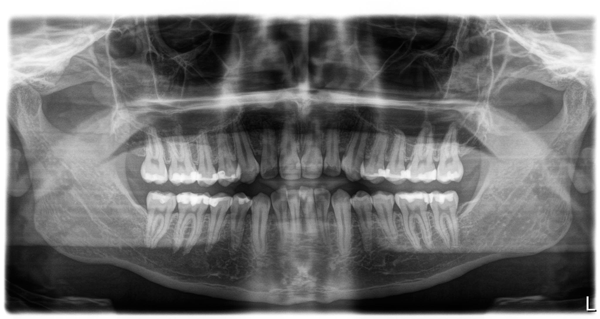 Full Mouth Rehabilitation
