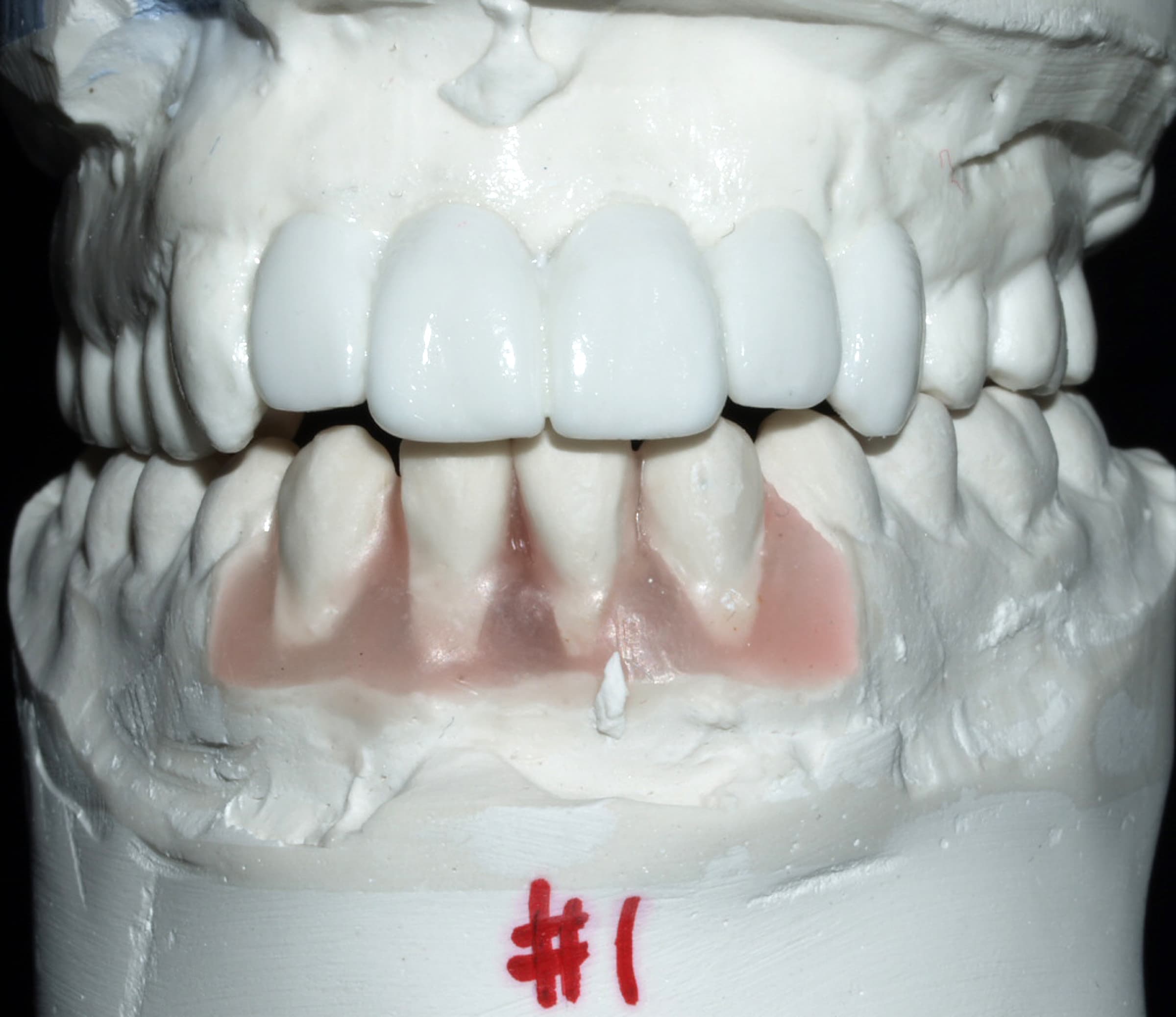 Implant Restoration